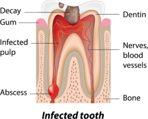 root canal treatment for infected tooth diagram