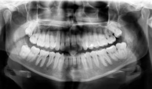 Dental X-Ray