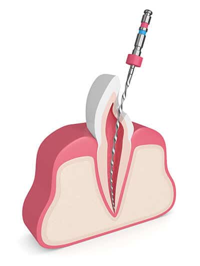 Root Canal