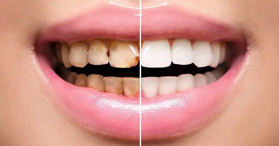 teeth whitening in Denver, CO